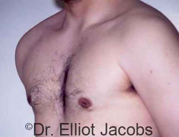 Gynecomastia Before & After Gallery - Patient 120163524 - Image 2
