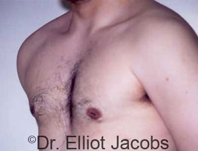Gynecomastia Before & After Gallery - Patient 120163524 - Image 2
