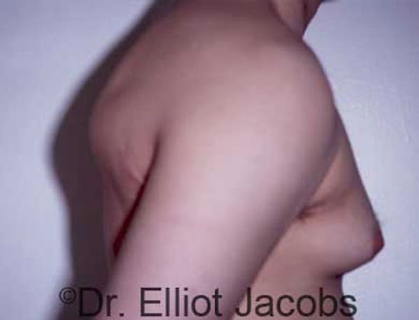 Gynecomastia Before & After Gallery - Patient 120163524 - Image 3