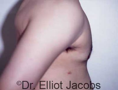 Gynecomastia Before & After Gallery - Patient 120163524 - Image 4