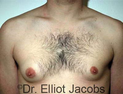 Gynecomastia Before & After Gallery - Patient 120163525 - Image 1