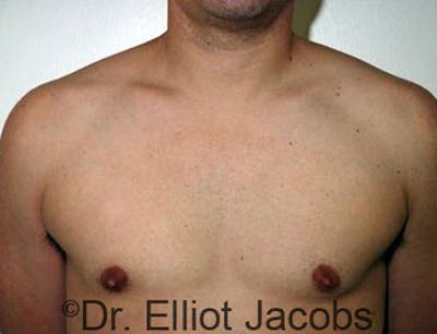 Gynecomastia Before & After Gallery - Patient 120163525 - Image 2