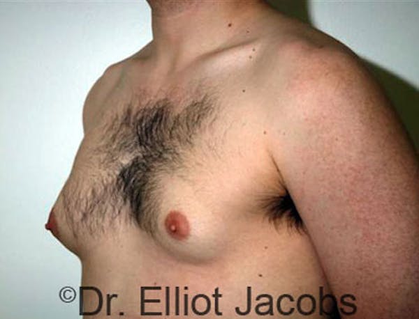 Gynecomastia Before & After Gallery - Patient 120163525 - Image 3
