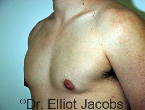 Gynecomastia Before & After Gallery - Patient 120163525 - Image 4