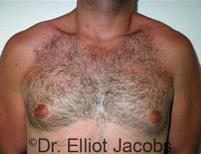 Gynecomastia Before & After Gallery - Patient 120163526 - Image 1