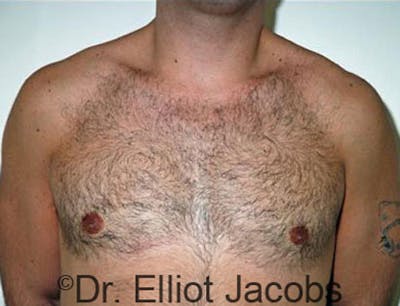 Gynecomastia Before & After Gallery - Patient 120163526 - Image 2