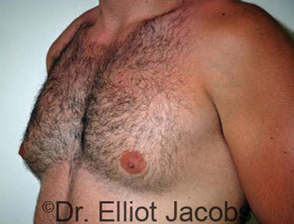 Gynecomastia Before & After Gallery - Patient 120163526 - Image 3