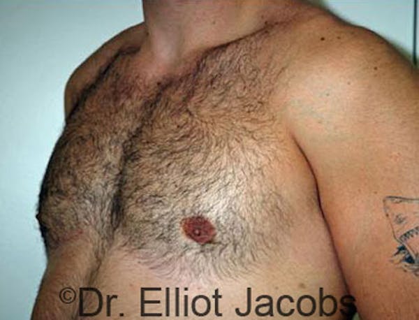 Gynecomastia Before & After Gallery - Patient 120163526 - Image 4