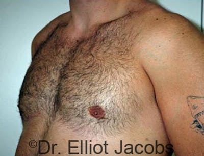 Gynecomastia Before & After Gallery - Patient 120163526 - Image 4