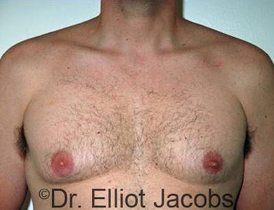 Gynecomastia Before & After Gallery - Patient 120163527 - Image 1