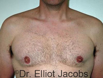 Gynecomastia Before & After Gallery - Patient 120163527 - Image 2