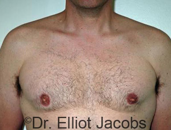 Gynecomastia Before & After Gallery - Patient 120163527 - Image 2