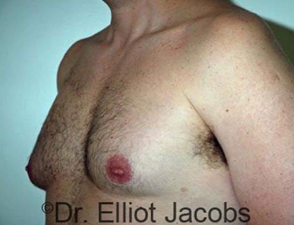 Gynecomastia Before & After Gallery - Patient 120163527 - Image 3