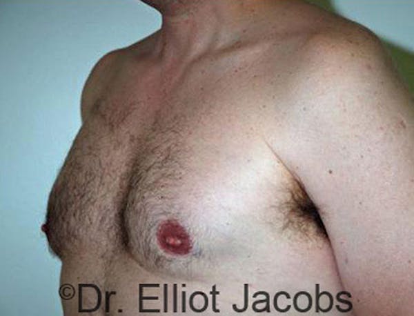 Gynecomastia Before & After Gallery - Patient 120163527 - Image 4