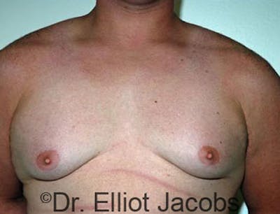 Gynecomastia Before & After Gallery - Patient 120163530 - Image 1