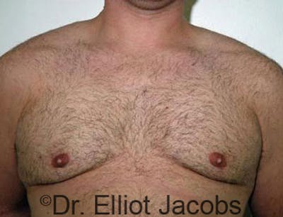 Gynecomastia Before & After Gallery - Patient 120163530 - Image 2