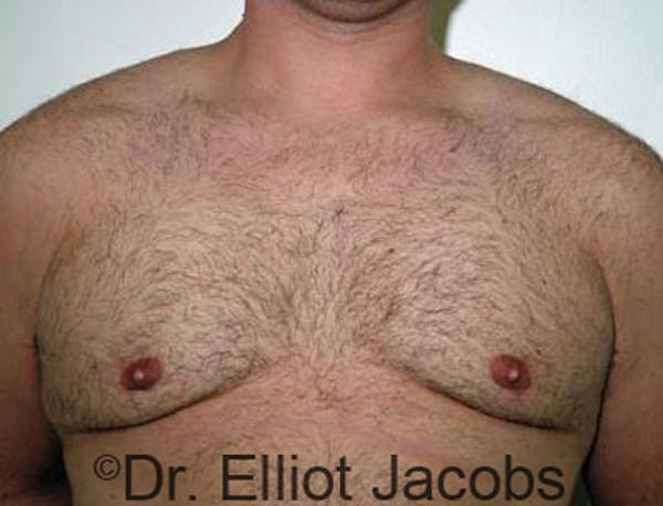 Gynecomastia Before & After Gallery - Patient 120163530 - Image 2