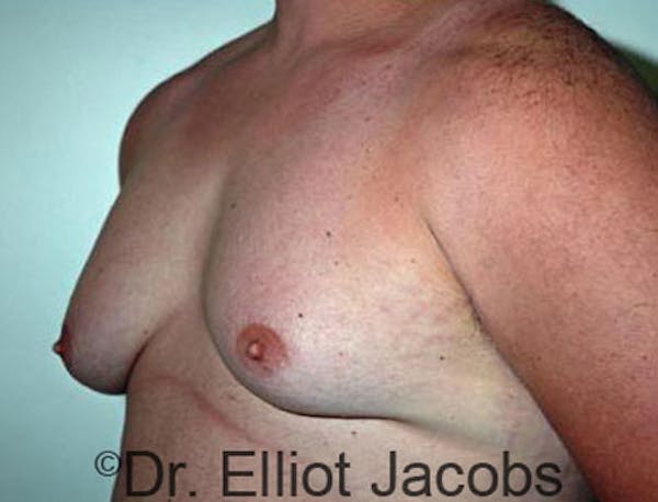 Gynecomastia Before & After Gallery - Patient 120163530 - Image 3