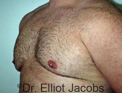 Gynecomastia Before & After Gallery - Patient 120163530 - Image 4