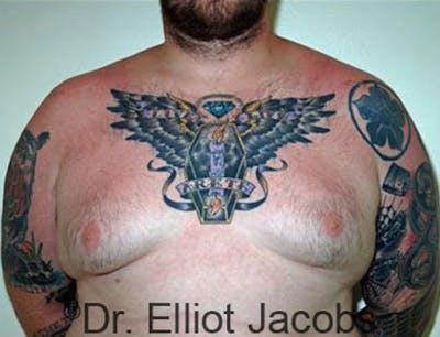 Gynecomastia Before & After Gallery - Patient 120163531 - Image 1