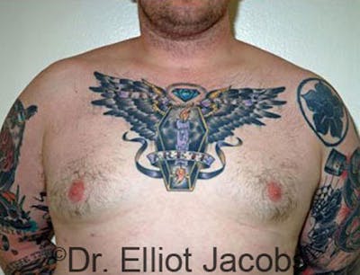 Gynecomastia Before & After Gallery - Patient 120163531 - Image 2