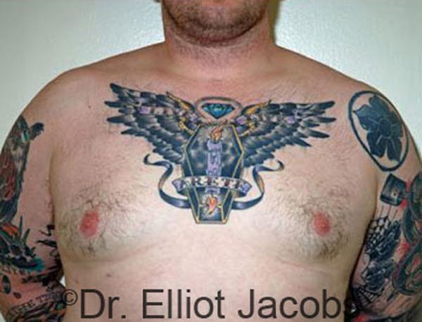 Gynecomastia Before & After Gallery - Patient 120163531 - Image 2