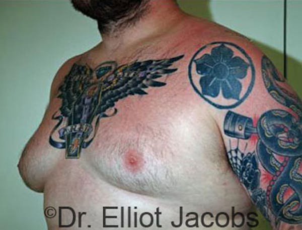 Gynecomastia Before & After Gallery - Patient 120163531 - Image 3
