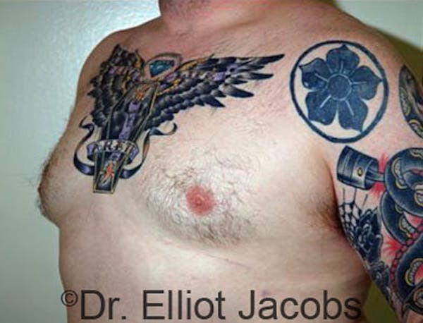 Gynecomastia Before & After Gallery - Patient 120163531 - Image 4