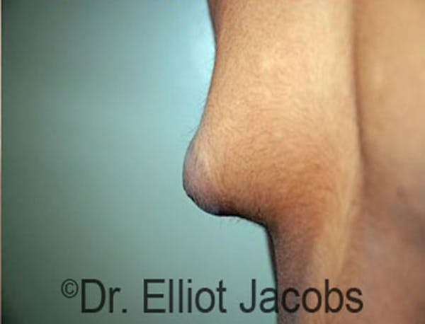 Puffy Nipples Before & After Gallery - Patient 120163563 - Image 3