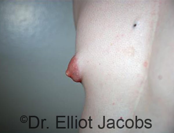 Puffy Nipples Before & After Gallery - Patient 120163565 - Image 1