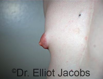 Puffy Nipples Before & After Gallery - Patient 120163565 - Image 1