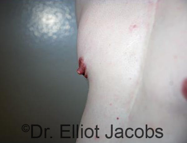 Puffy Nipples Before & After Gallery - Patient 120163565 - Image 2