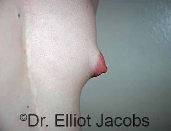 Puffy Nipples Before & After Gallery - Patient 120163565 - Image 3