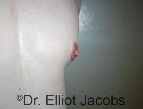 puffies nip Puffy Nipples Before & After Photos | XSculpt™