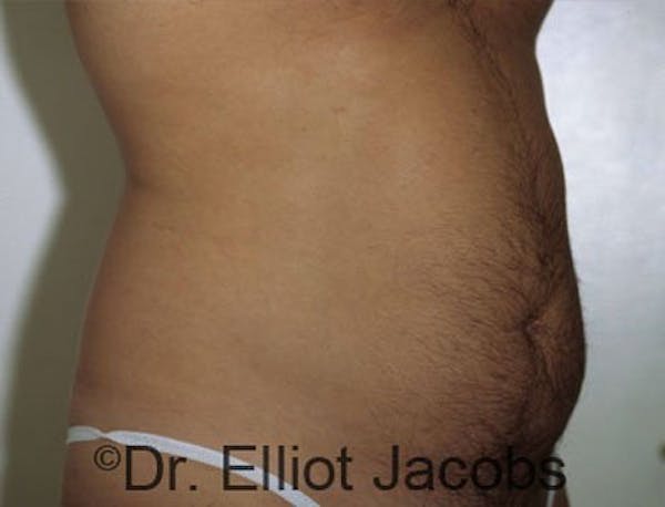 Torsoplasty Before & After Gallery - Patient 120163586 - Image 3