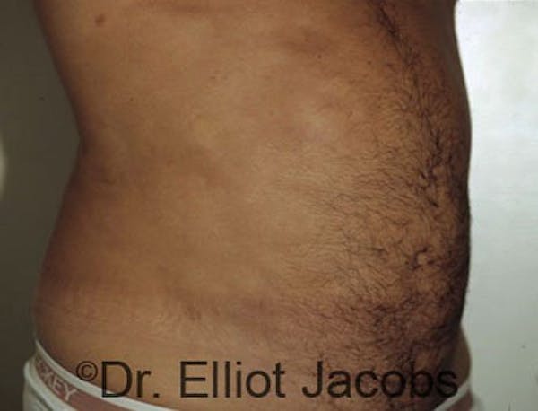 Torsoplasty Before & After Gallery - Patient 120163586 - Image 4