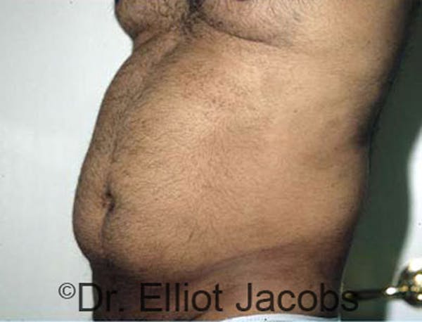 Torsoplasty Before & After Gallery - Patient 120163587 - Image 3