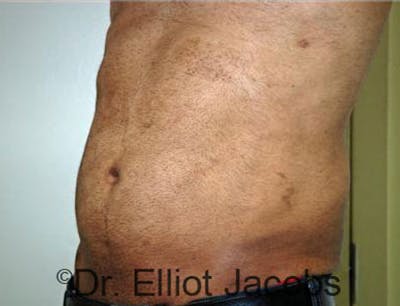 Torsoplasty Before & After Gallery - Patient 120163587 - Image 4