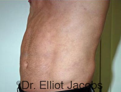 Torsoplasty Before & After Gallery - Patient 120163588 - Image 4