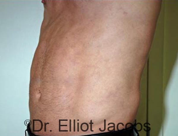 Torsoplasty Before & After Gallery - Patient 120163588 - Image 4