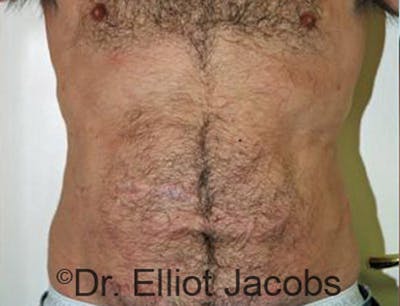 Torsoplasty Before & After Gallery - Patient 120163589 - Image 2