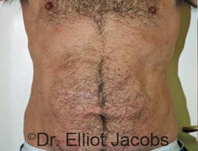 Torsoplasty Before & After Gallery - Patient 120163589 - Image 2