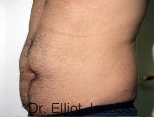 Torsoplasty Before & After Gallery - Patient 120163589 - Image 3