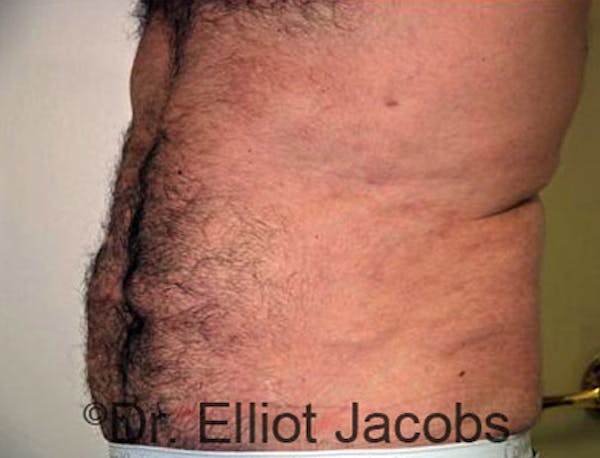 Torsoplasty Before & After Gallery - Patient 120163589 - Image 4