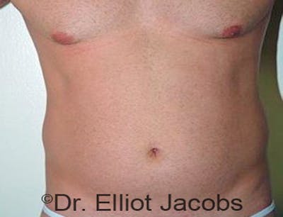 Torsoplasty Before & After Gallery - Patient 120163590 - Image 1