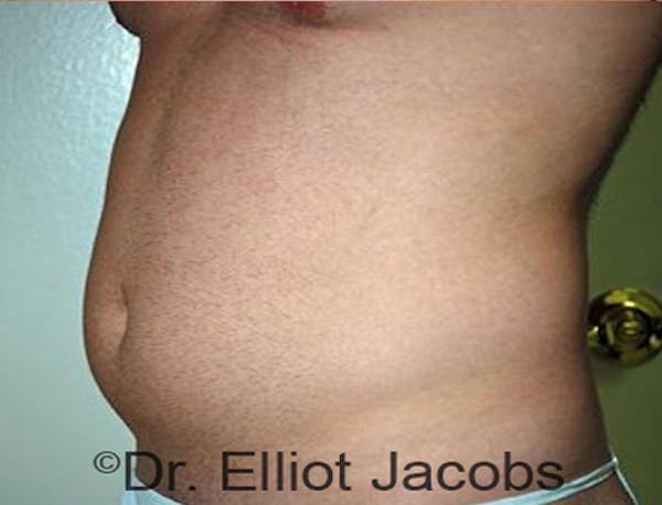 Torsoplasty Before & After Gallery - Patient 120163590 - Image 3