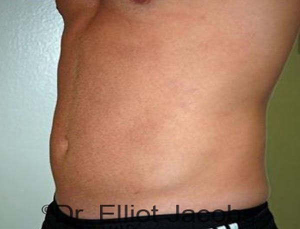 Torsoplasty Before & After Gallery - Patient 120163590 - Image 4