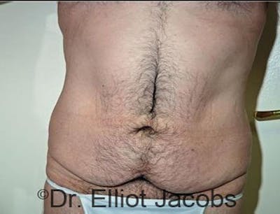 Torsoplasty Before & After Gallery - Patient 120163591 - Image 1