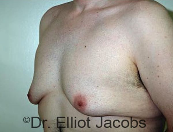 Torsoplasty Before & After Gallery - Patient 120163591 - Image 3