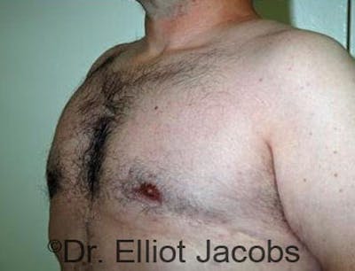 Torsoplasty Before & After Gallery - Patient 120163591 - Image 4